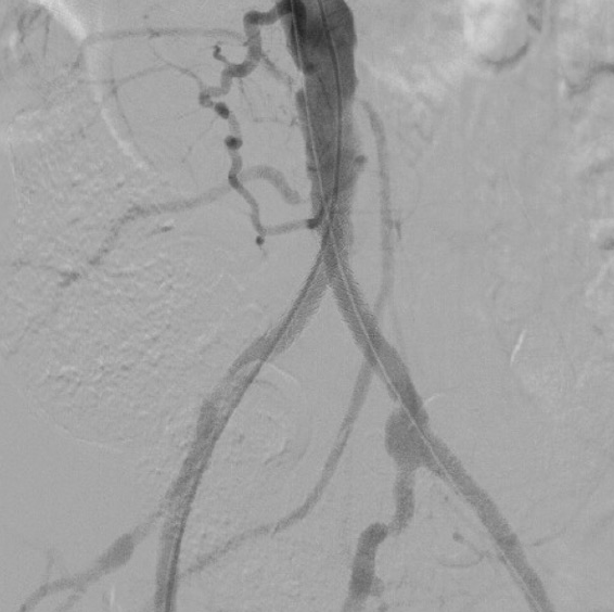 Figure 3. Post-deployment angiogram.