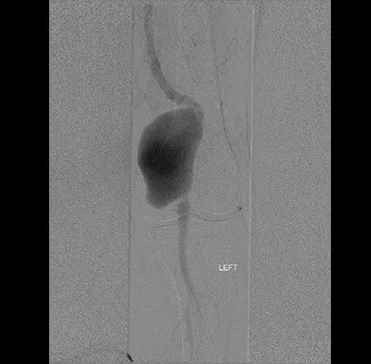 angiogram