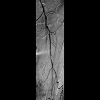 iliac chronic total occlusion