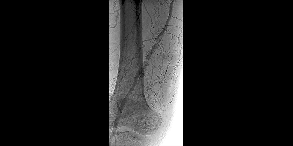 angiogram