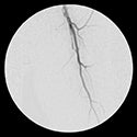 Claudication