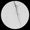 external iliac artery stenosis