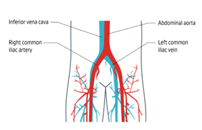 Anatomy image labeling the abdominal aorta, iliac vein, iliac artery and inferior vena cava.