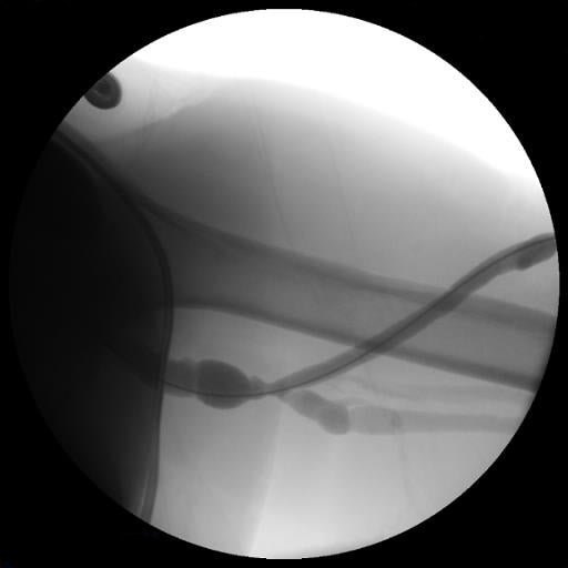 Fistulography with recurrent stenosis noted at venous outflow anastomosis.