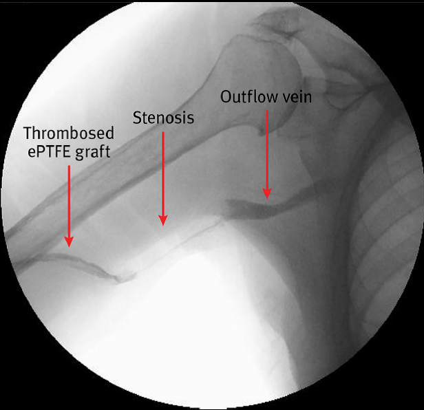 angiogram