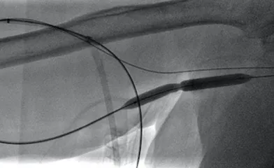 angiogram