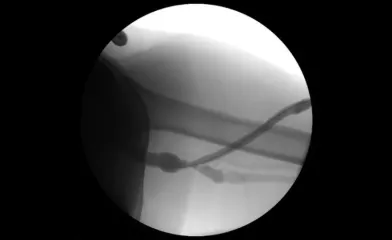 Fistulography with recurrent stenosis noted at venous outflow anastomosis.