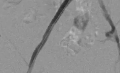 Radial access approach to iliac artery occlusion utilizing the lower profile VBX Stent Graft