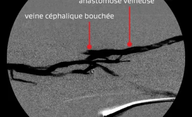 Angiogramme montrant une anastomose veineuse et une veine céphalique bouchée après la première intervention