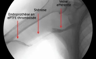 Sténose de l'anastomose veineuse avec thrombose