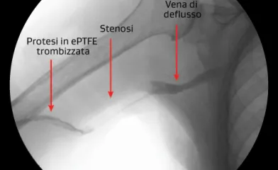Stenosi venosa con trombosi