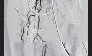 図3 治療前アンギオ