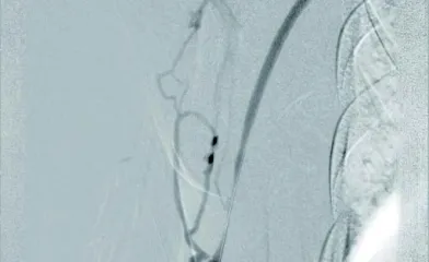 静脈側吻合部病変 