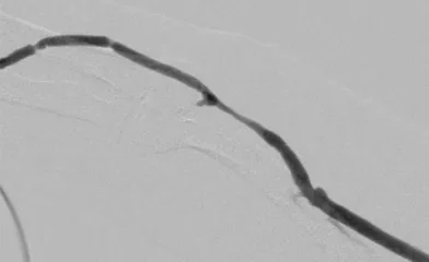 図1 人工血管に 5－0 ナイロンでマットレス縫合をかけてその中心部を穿刺しシースを挿入して造影