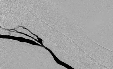 図1：PTA 前血管造影