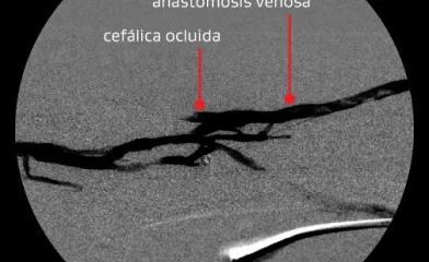 Angiograma que muestra la anastomosis venosa y la cefálica ocluida tras la primera intervención