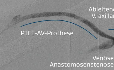 Abbildung der rechten brachialaxillären AV-Prothese mit Stenose an der venösen Anastomose