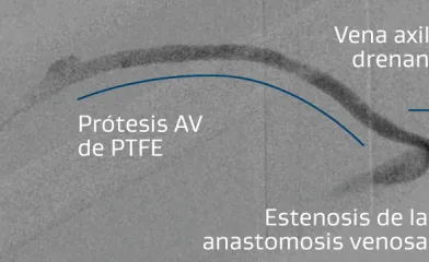 Representación de la prótesis AV braquio-axilar derecha con estenosis en la anastomosis venosa.