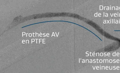 Illustration de la prothèse AV brachio-axillaire droite présentant une sténose au niveau de l'anastomose veineuse