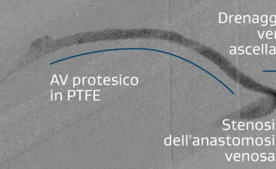 Illustrazione della protesi AV brachiale ascellare destra con stenosi a livello dell'anastomosi venosa