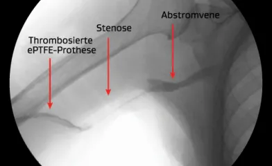 Venöse Anastomosenstenose mit Thrombose