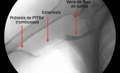 Estenosis de la anastomosis venosa con trombosis 