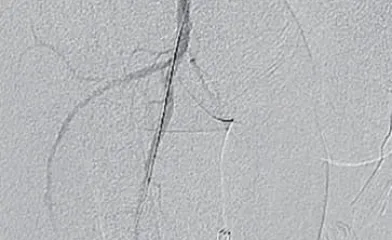 図1大腿部・術前