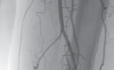 図2 治療前DSA画像