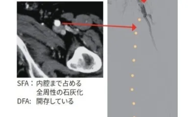 図1 右鼠径から6 Fr ガイディングカテーテルを挿入しcross overで施行