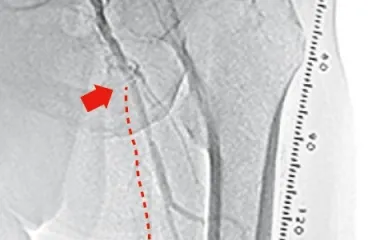 図1 左浅大動脈入口部近位での閉塞