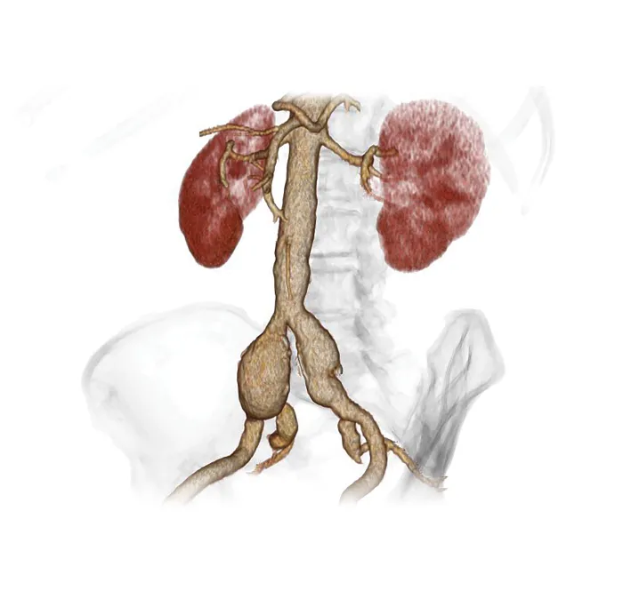 Hypogastric artery preservation