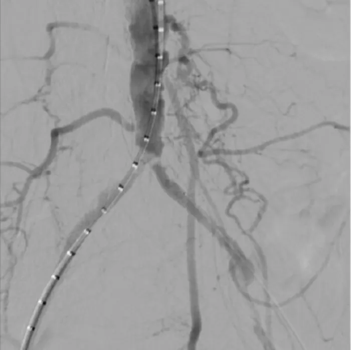 Figure 1. Aortoiliac occlusive disease at aortic bifurcation.