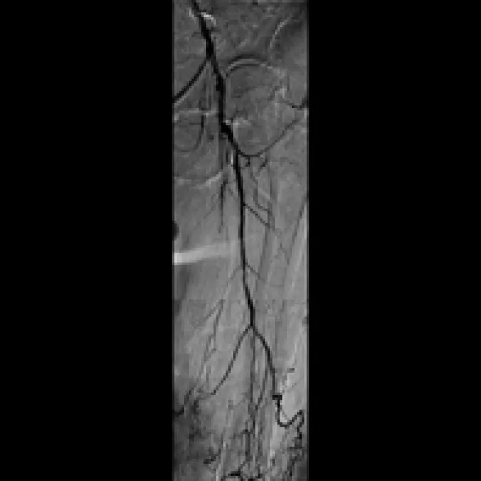 Non-healing ulcer with SFA disease 