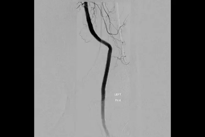 angiogram