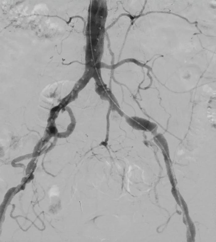 A modern approach to iliac artery stenting utilizing the lower profile VBX Stent Graft
