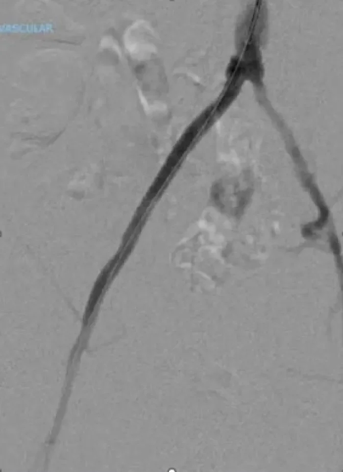 Radial access approach to iliac artery occlusion utilizing the lower profile VBX Stent Graft