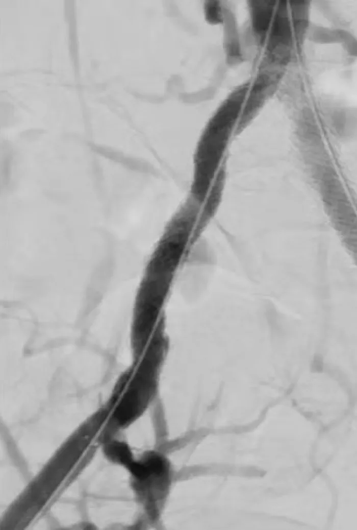 Reconstructing the aortic bifurcation