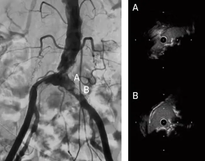 Restoring flow to a patient with stenosis at the aortoiliac bifurcation
