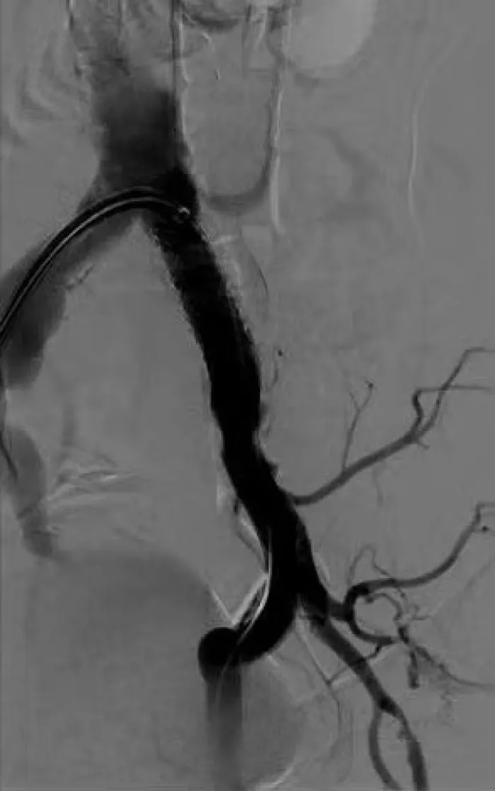 Treating a severely calcified lesion