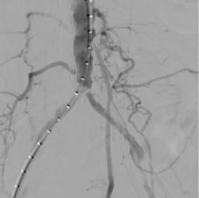 Treating severe aortoiliac occlusive disease (AIOD) at the aortic bifurcation