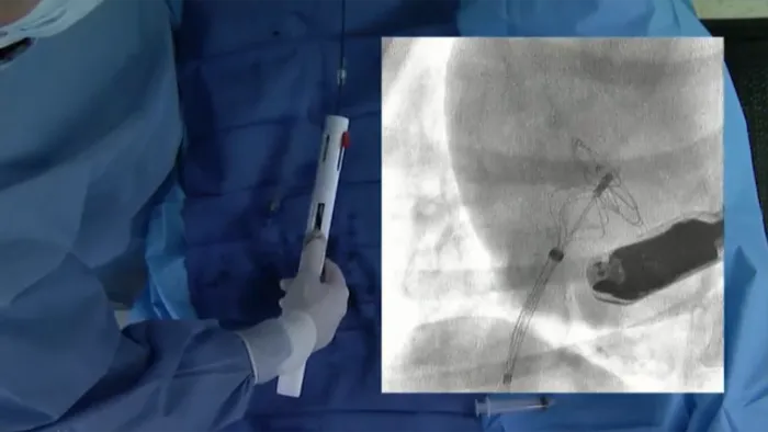 カーディオフォーム セプタルオクルーダー 展開