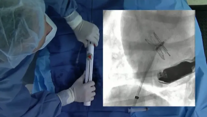 カーディオフォーム セプタルオクルーダー ロック