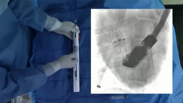 カーディオフォーム セプタルオクルーダー リリース