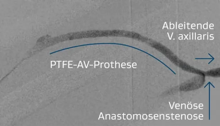 Rechte brachialaxilläre AV-Prothese mit Stenose an der venösen Anastomose