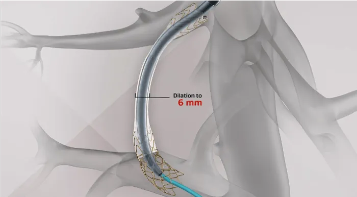 Medical illustration showing a balloon catheter inside a curved covered stent graft within a blood vessel. A callout labeled “Dilation to 6 mm” indicates the balloon expanding the graft to a 6 mm diameter.