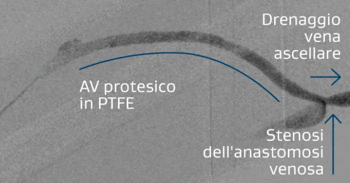 Protesi AV brachiale ascellare destra con stenosi a livello dell'anastomosi venosa 