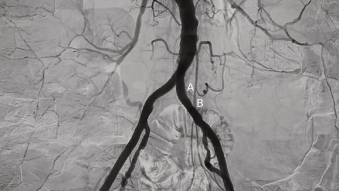 Angiographic image of the abdominal aorta and iliac artery bifurcation, with labels A and B marking locations near the left iliac artery.