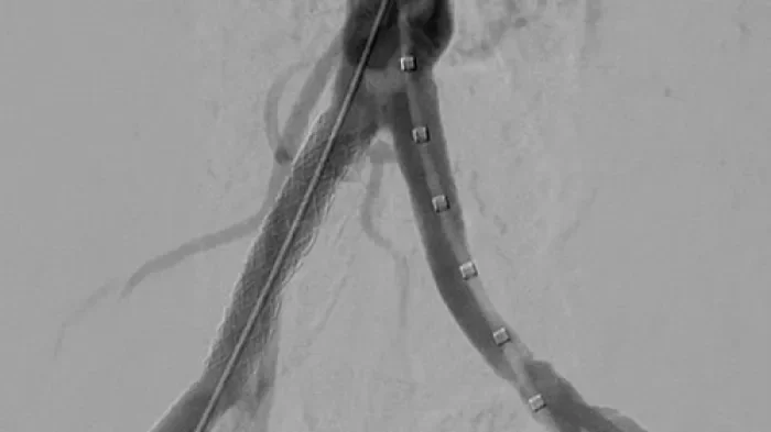 Angiographic image showing an endovascular stent extending through an iliac artery, with contrast outlining the treated vessel.