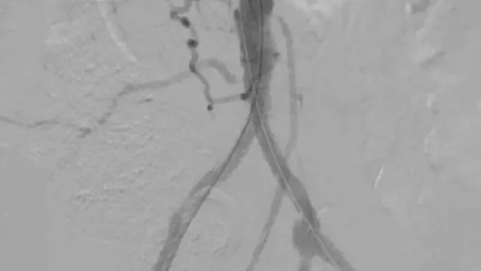 Angiographic image showing stents extending from the abdominal aorta into both iliac arteries to treat severe aortoiliac occlusive disease.