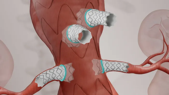 Medical illustration of a fenestrated endovascular aortic repair (fEVAR), showing a stent graft in the abdominal aorta with branch stents extending into both renal arteries and additional branch vessels.